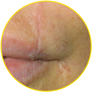 Sunken (atrophic) scar