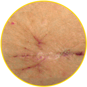 Reddish scar