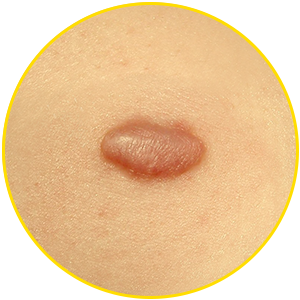 Exceedingly growing scar (keloid)