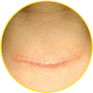 Raised (hypertrophic) scar