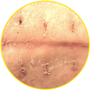 Fresh scar on thigh