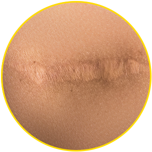 scar on upper body